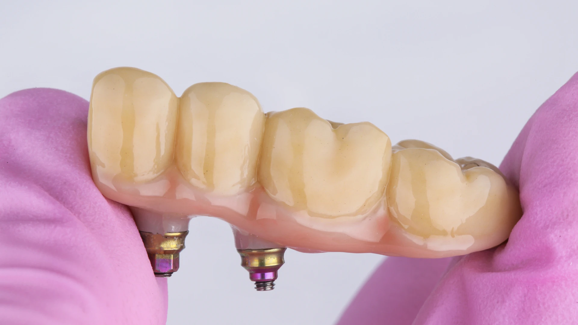 Close-up of dental bridges model used in tooth replacement