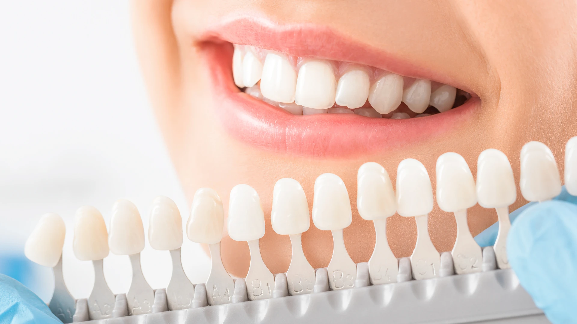 Before and after results of professional teeth whitening