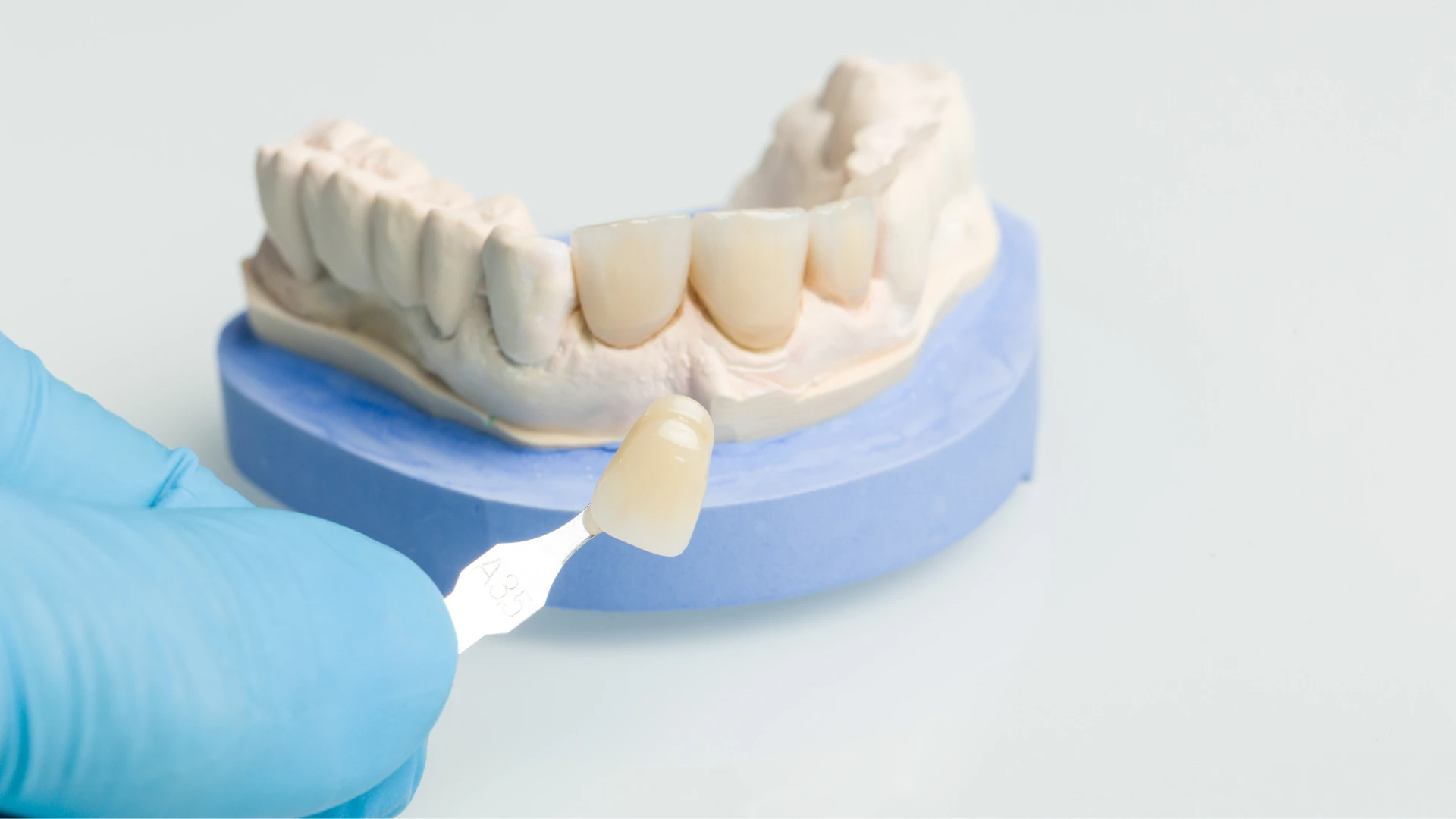 Dental crowns placed on model teeth for restorative treatment